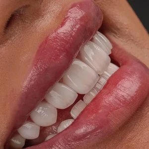 Composite bonding for tooth restoration