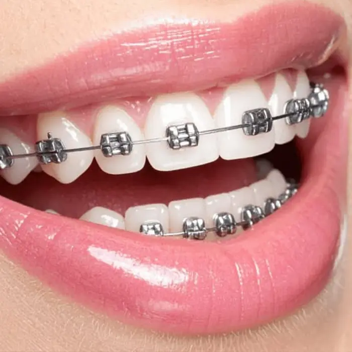 Orthodontic treatment for straighter teeth