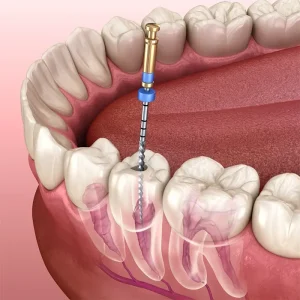 Root canal treatment procedure