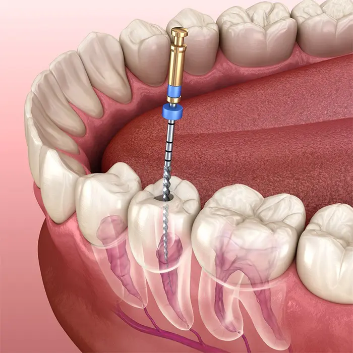 Root canal treatment procedure