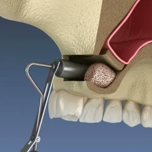 Sinus lift surgery for dental implants