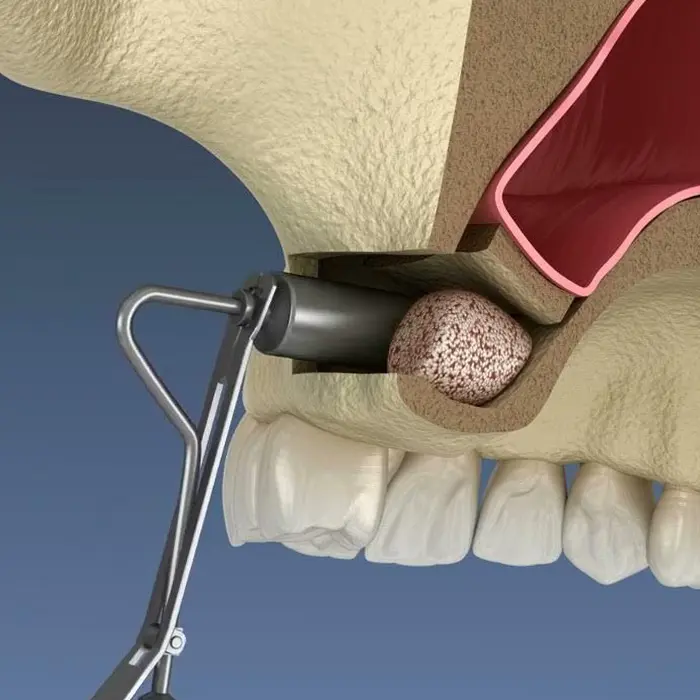 Sinus lift surgery for dental implants